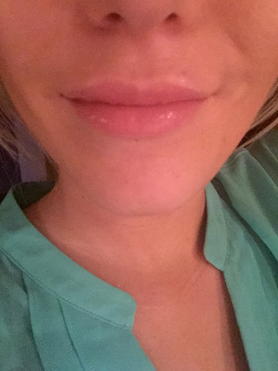 My Restylane Lip Injections Med Spa Reviews