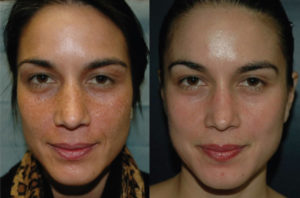 Before and after VI Peel with Precision Booster