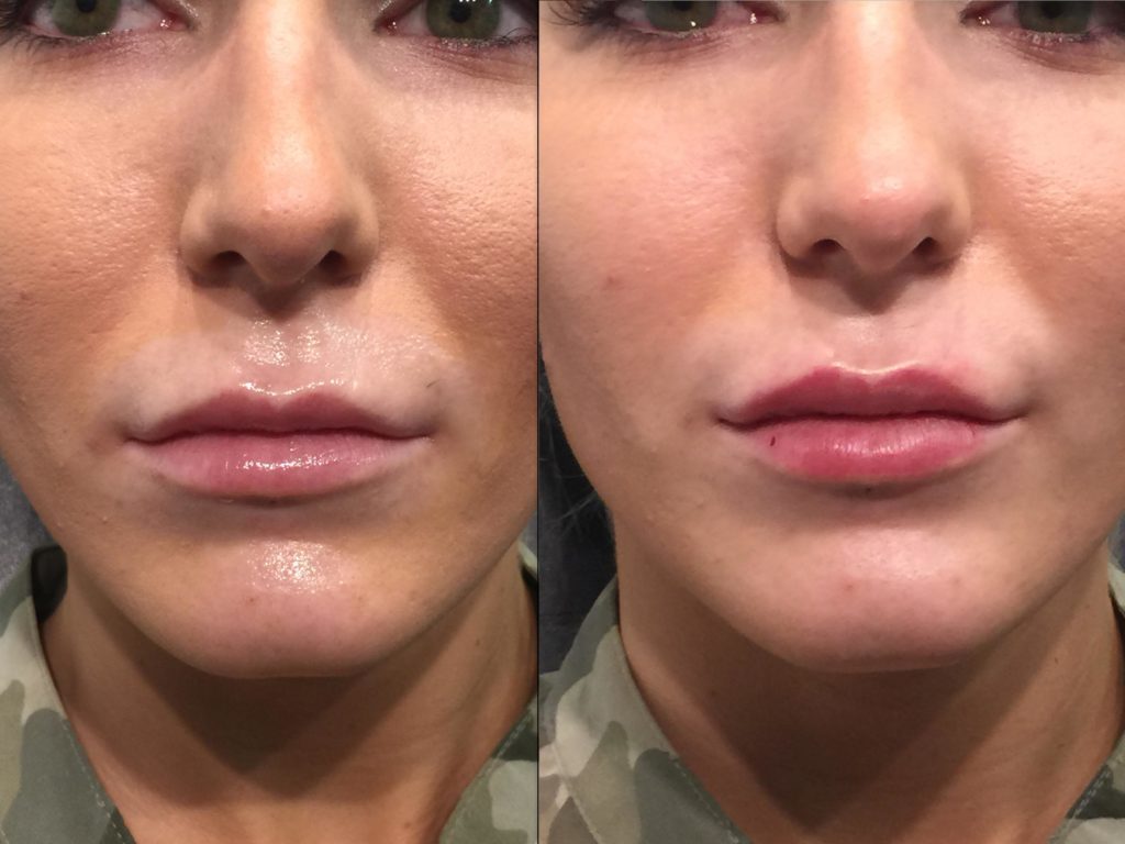 My Restylane Lip Injections Med Spa Reviews 4515