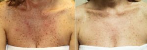 Before and after 2 VI Peels on the decollate