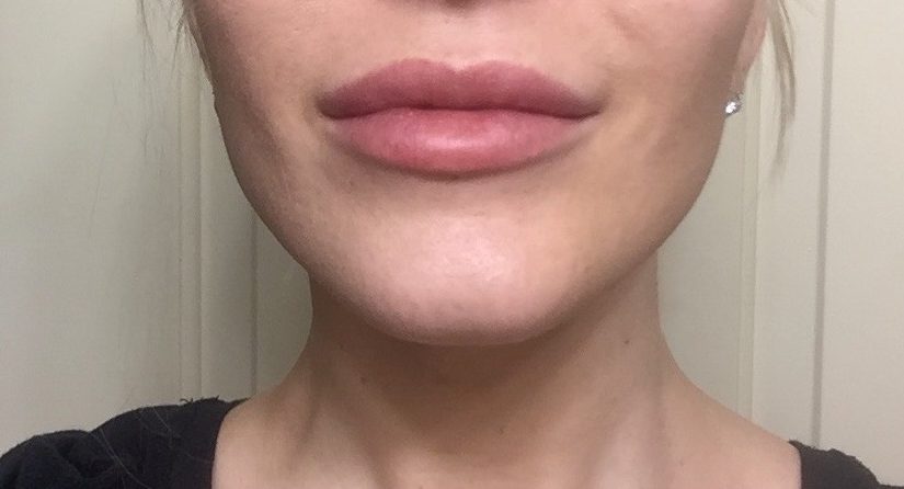 Lips after Juvederm Ultra Plus XC injections