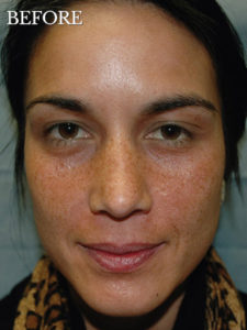 Hyperpigmentation and sunspots before VI Peel